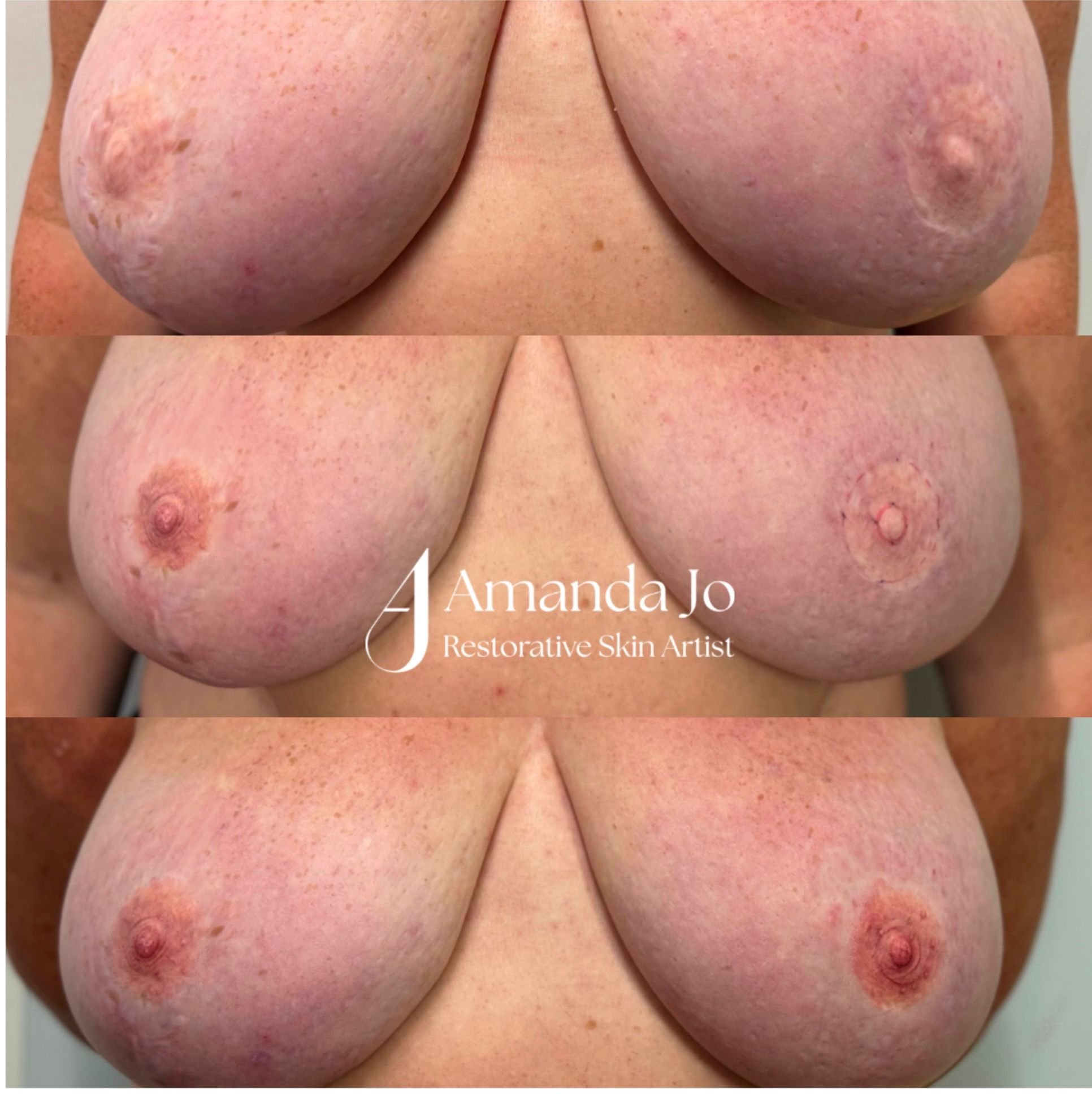 Before, during and after Areola tattoo