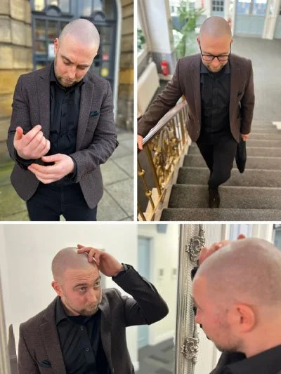 Men's Scalp Micropigmentation SMP
