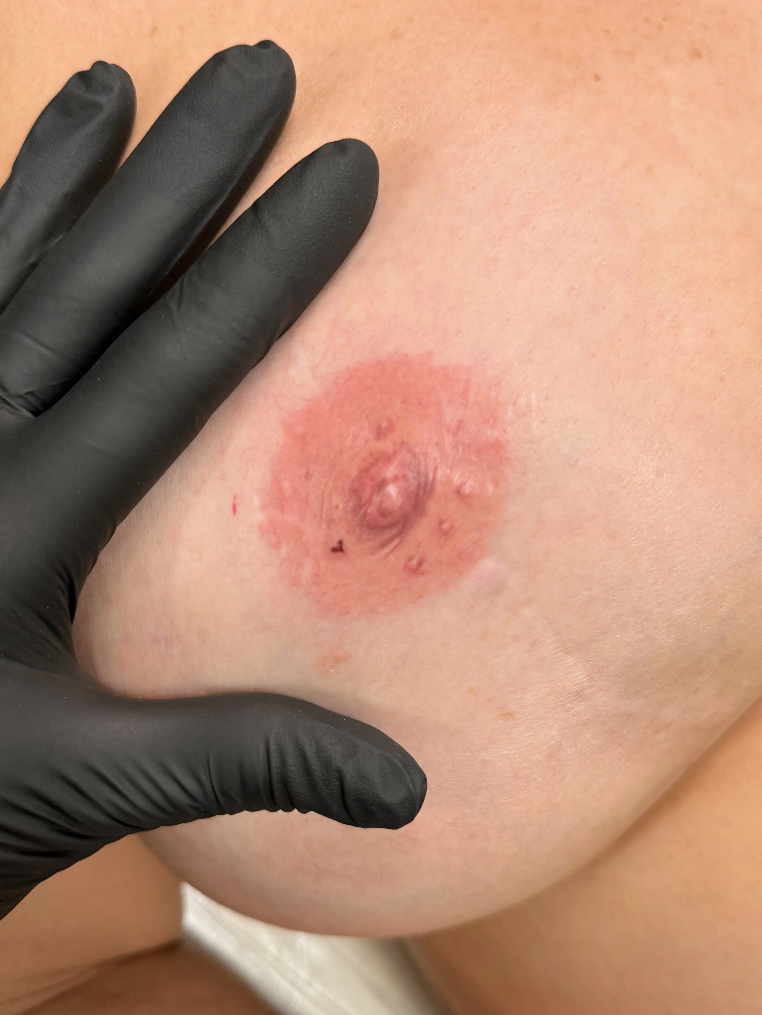 Close-up of a person's skin with a small, irritated bump and redness, being examined by a hand wearing a black glove.
