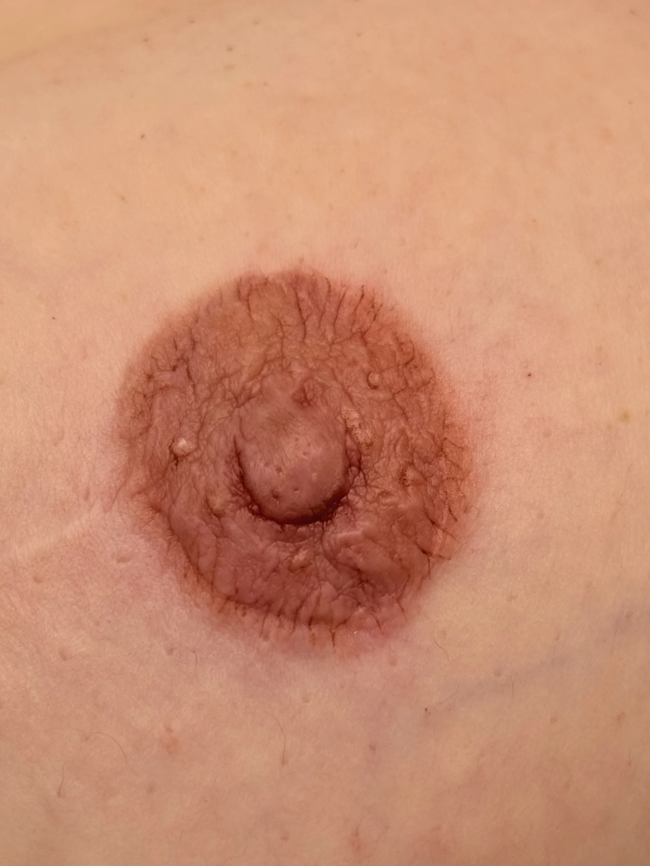 Areola - Nipple Complex (ANC) on Areola skin graft. Tattooed to improve colour and texture.