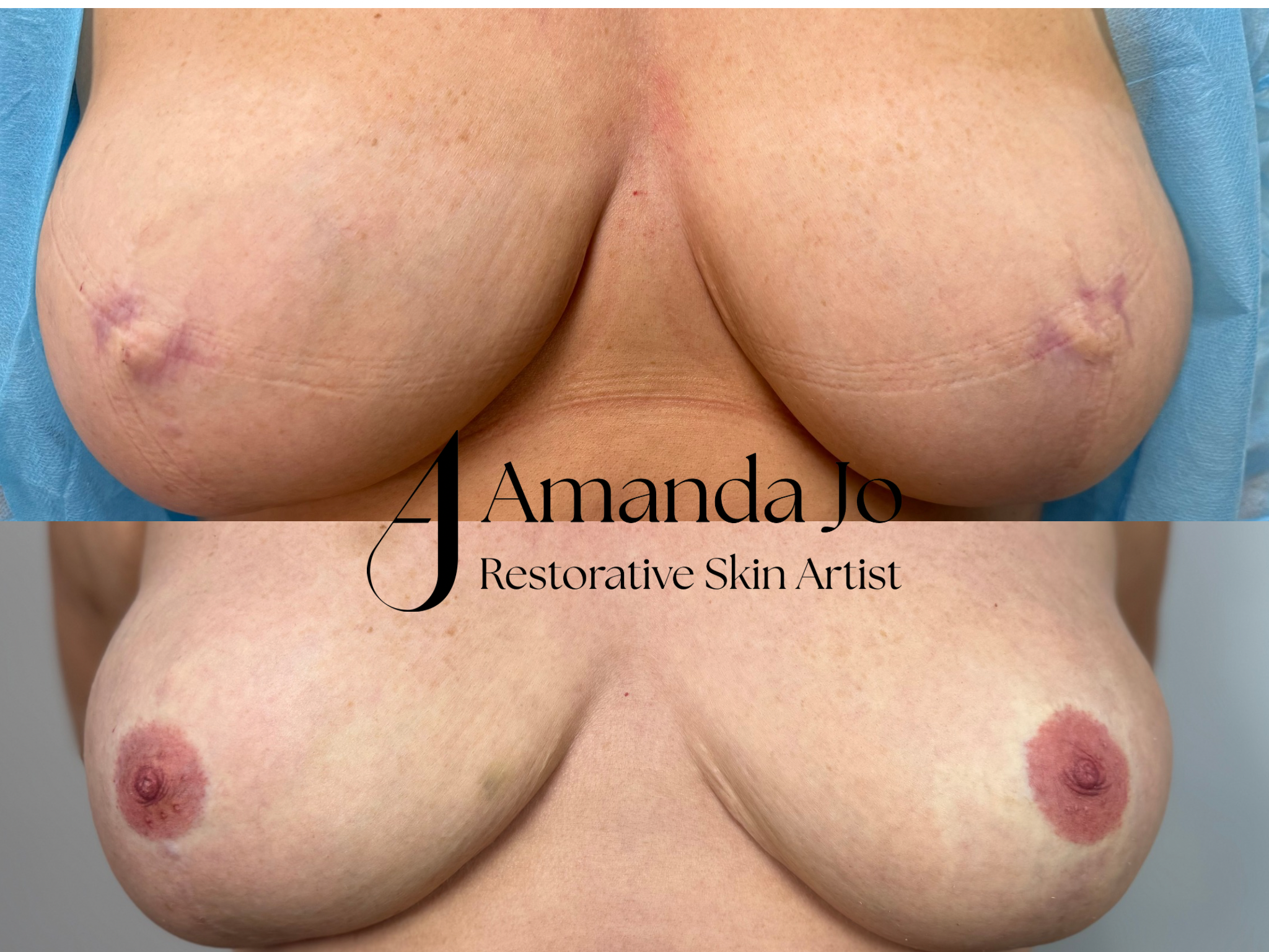Close-up of a person's naked chest with scars and healed wounds, with a business card overlaying part of the chest. The scars are pink and purple, indicating recent healing.