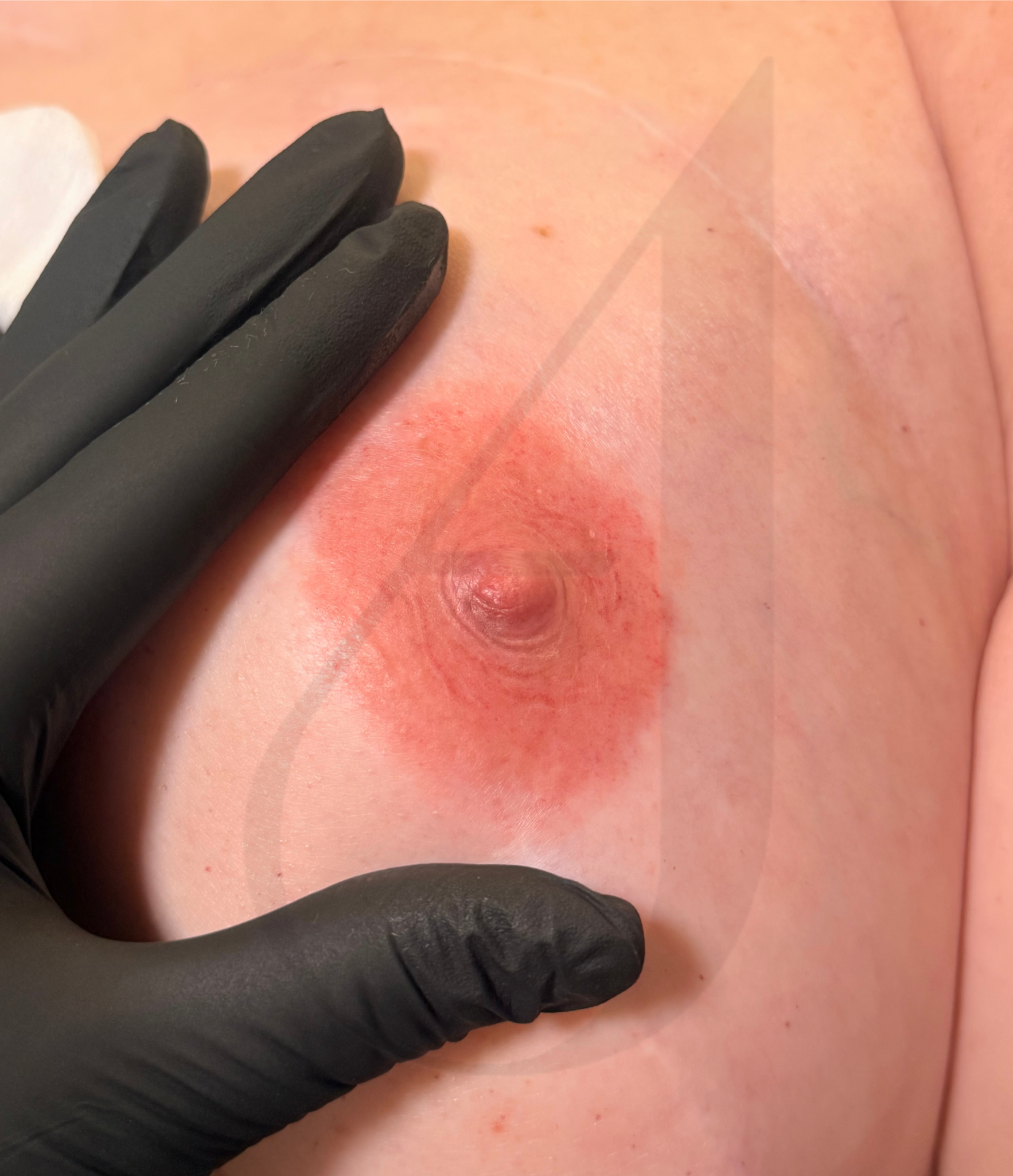 Areola Tattoo on reconstructed nipple.