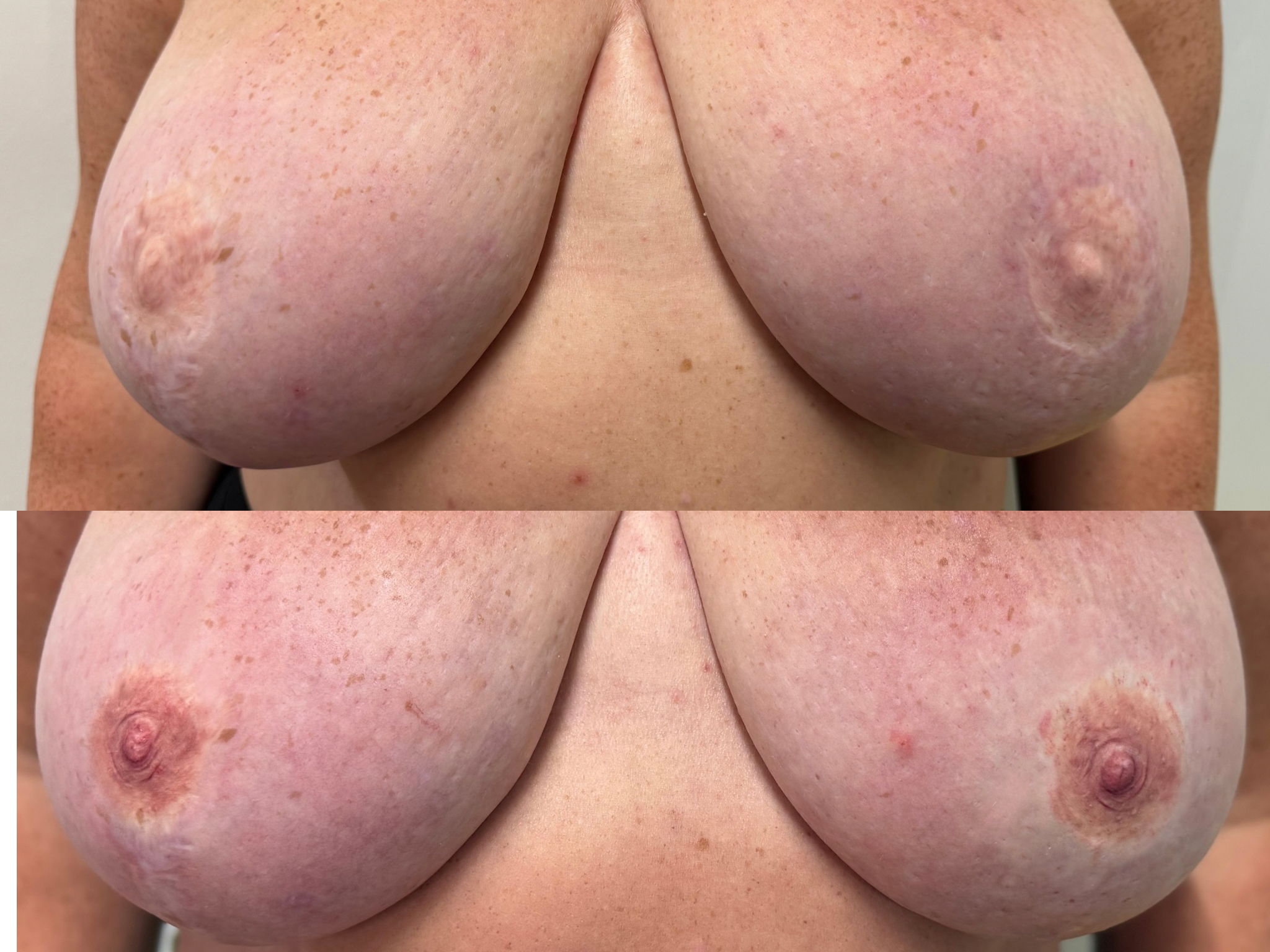 Close-up of a person's bare breasts showing before and after results with freckles, moles, and some skin imperfections.