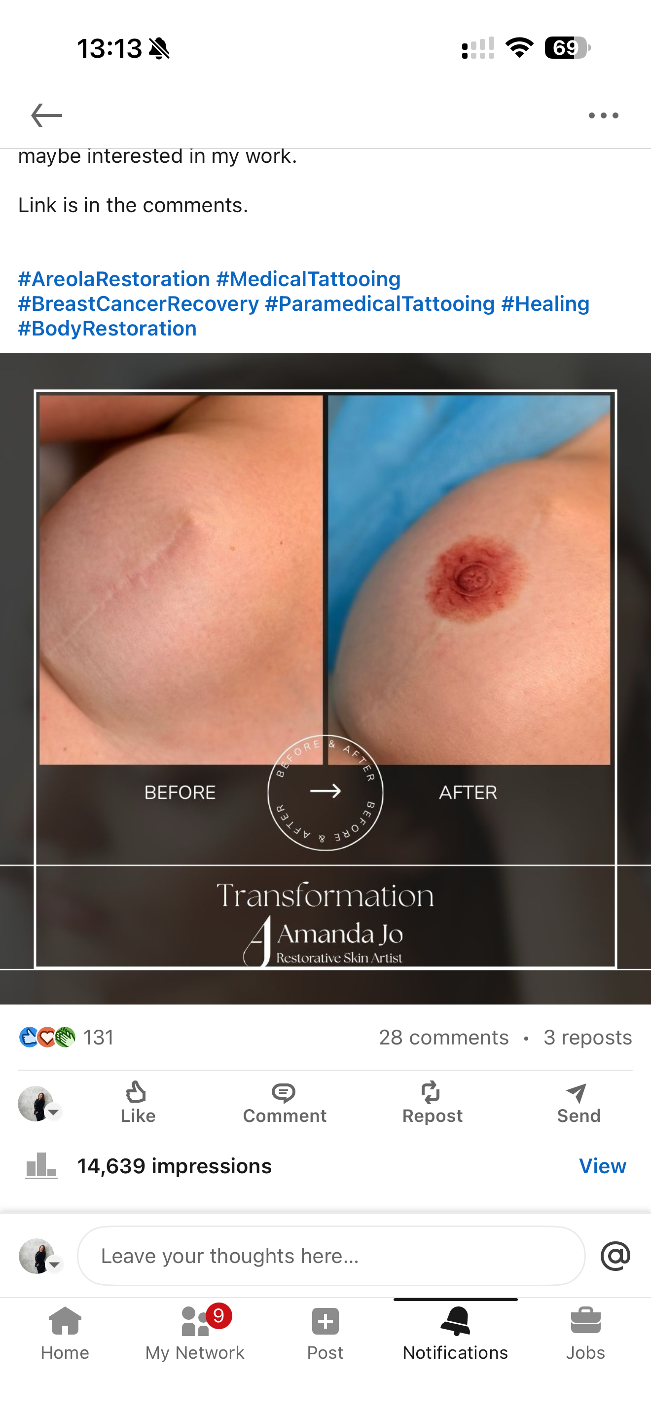 Before & After of Areola - Nipple Complex on flat skin after Mastectomy and reconstruction