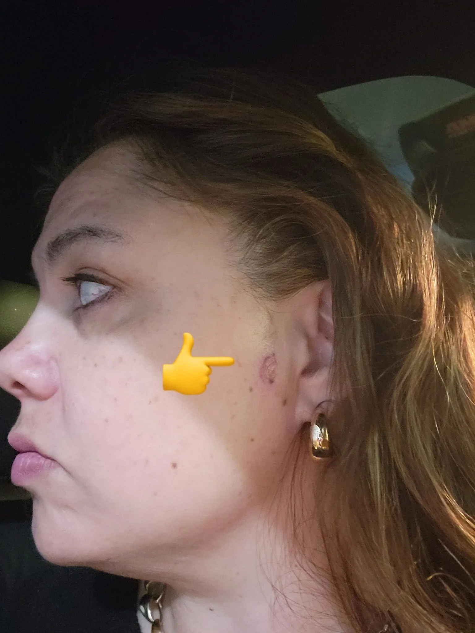 This is your sign to go get your moles/spots checked! I had skin cancer in my early 20s. The drs disregarded my concern given my ethnicity, age and that it was completely covered by my hair. Since then I have gone in every year for a body check. Toda