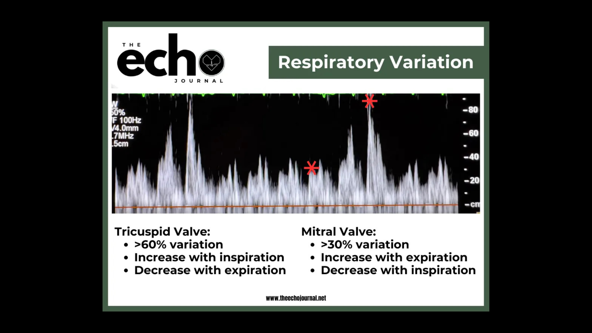 You Found an Effusion, Now What? Echo Recognition of Tamponade