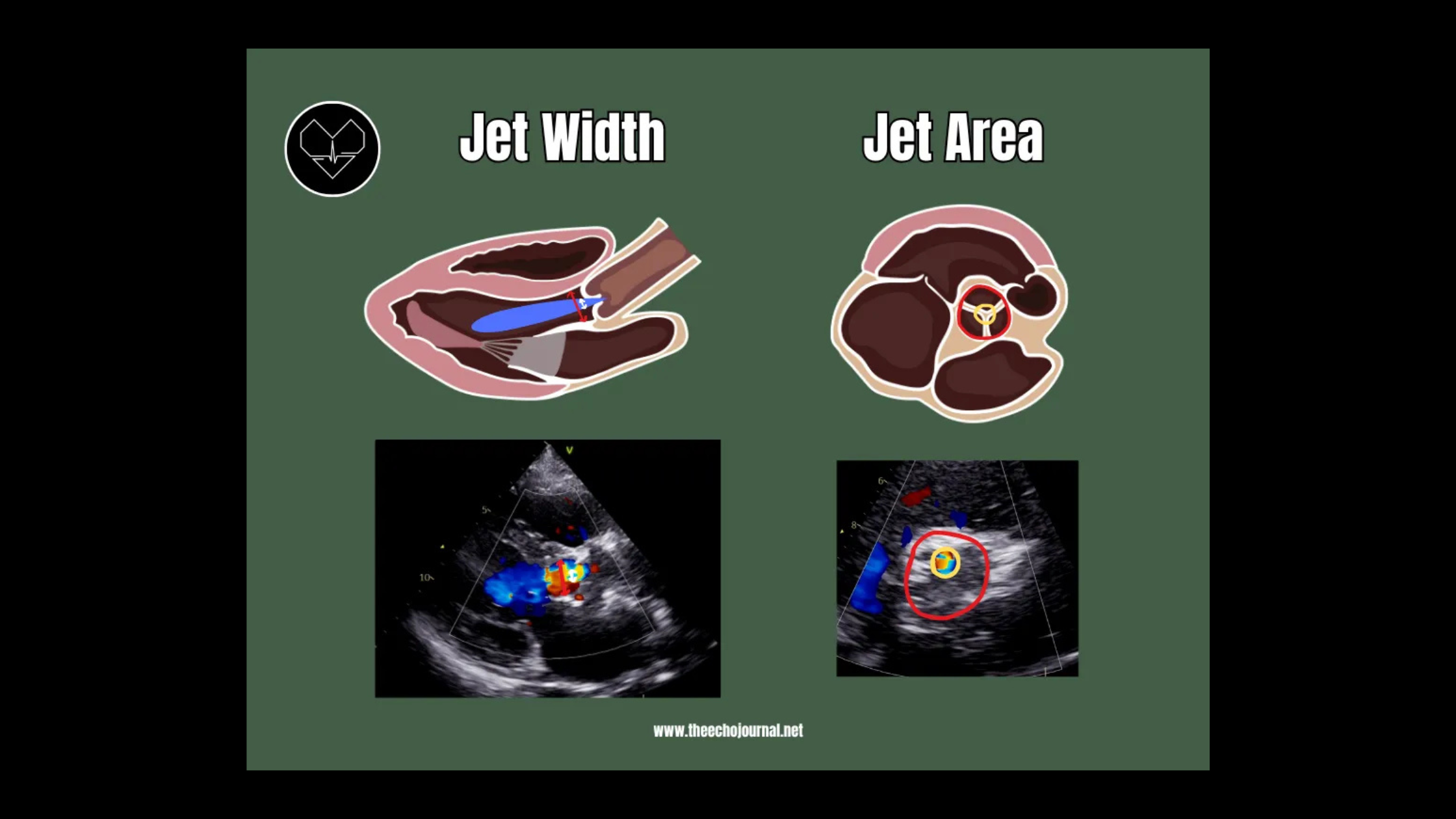 Mastering Aortic Regurgitation: A Practical Echo Guide