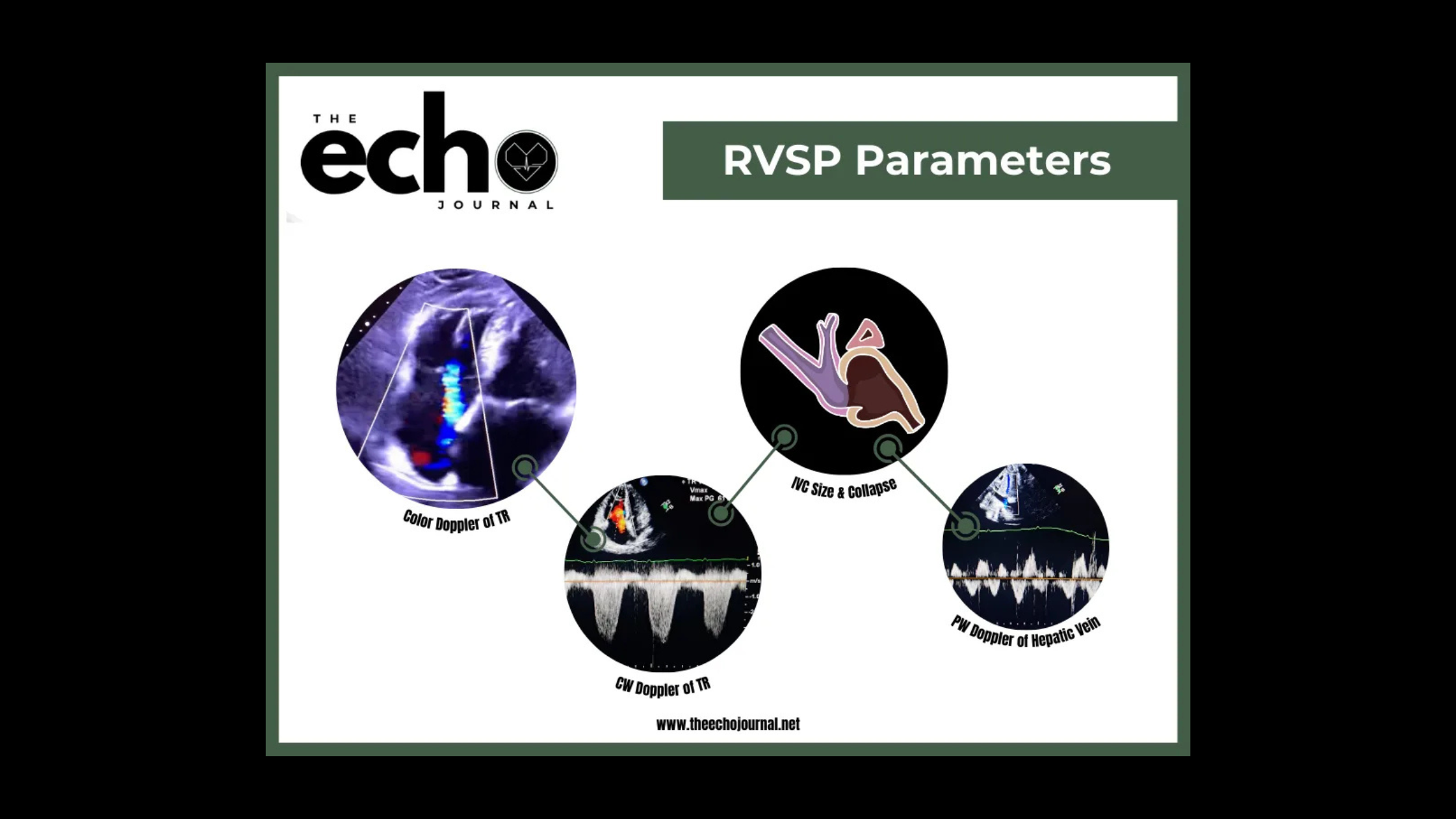 RVSP in Tricuspid Regurgitation: Useful Marker or Misleading Metric?