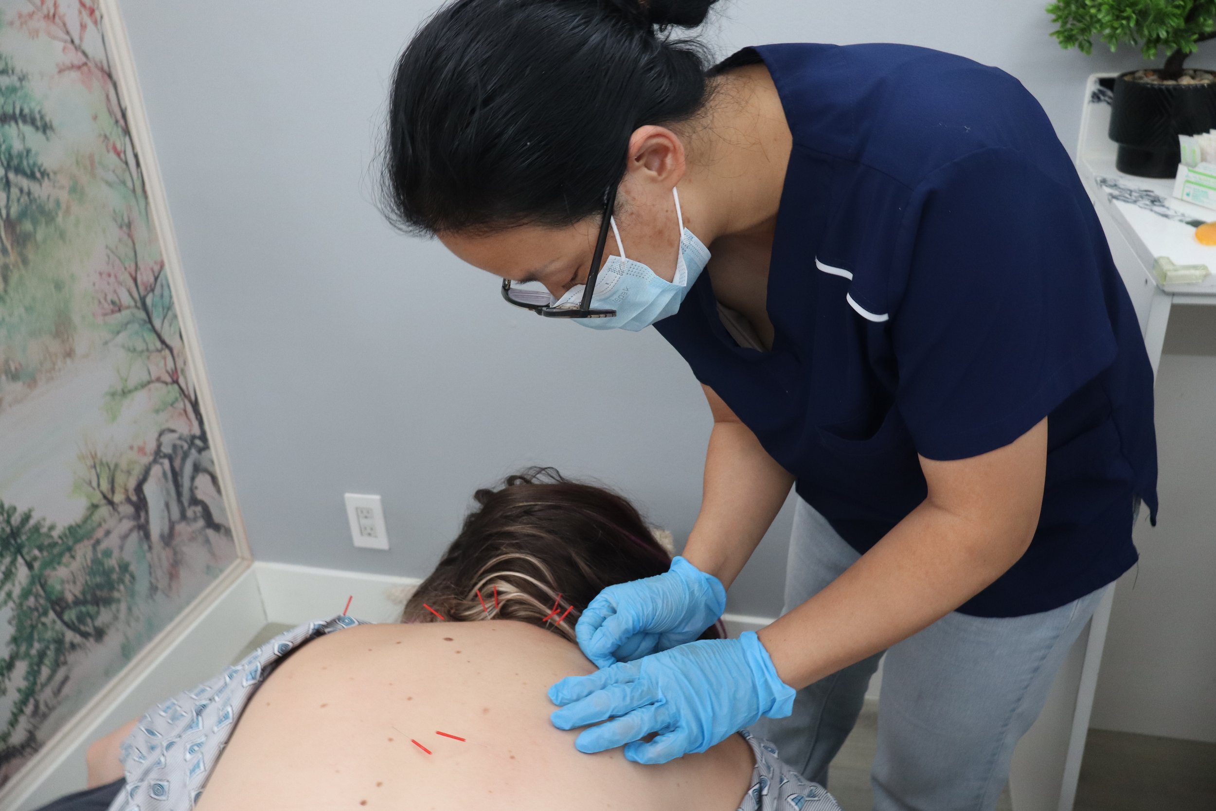 TCM Acupuncture in Coral Springs