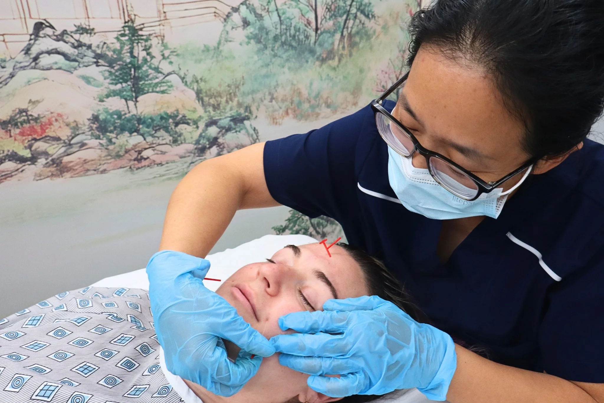 Facial Acupuncture in Coral Springs