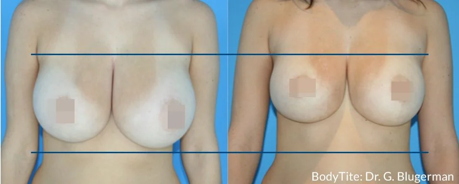BodyTite_GB_DS_Breast1.jpg