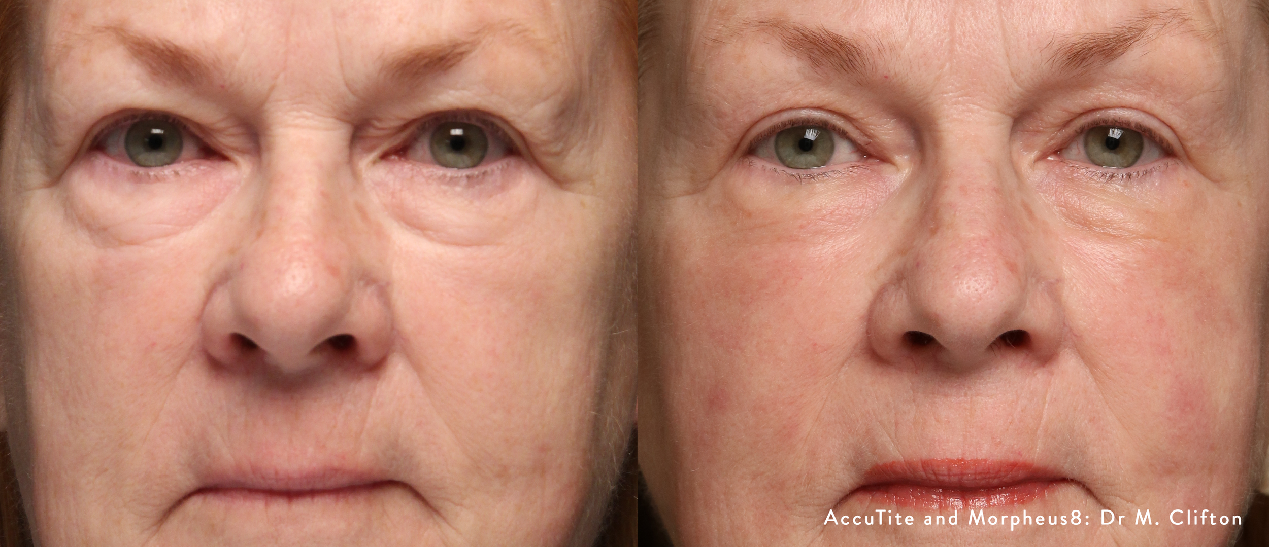 accutite-morpheus8-before-after-dr-m-clifton-preview-1.png