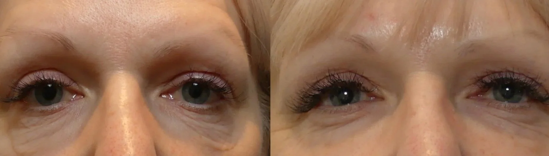 Close-up side-by-side comparison of a woman's eye area, showing individual wrinkles and skin texture before (left) and after (right) a cosmetic treatment. The right side shows smoother skin with fewer wrinkles. The bottom right corner has text: Morph
