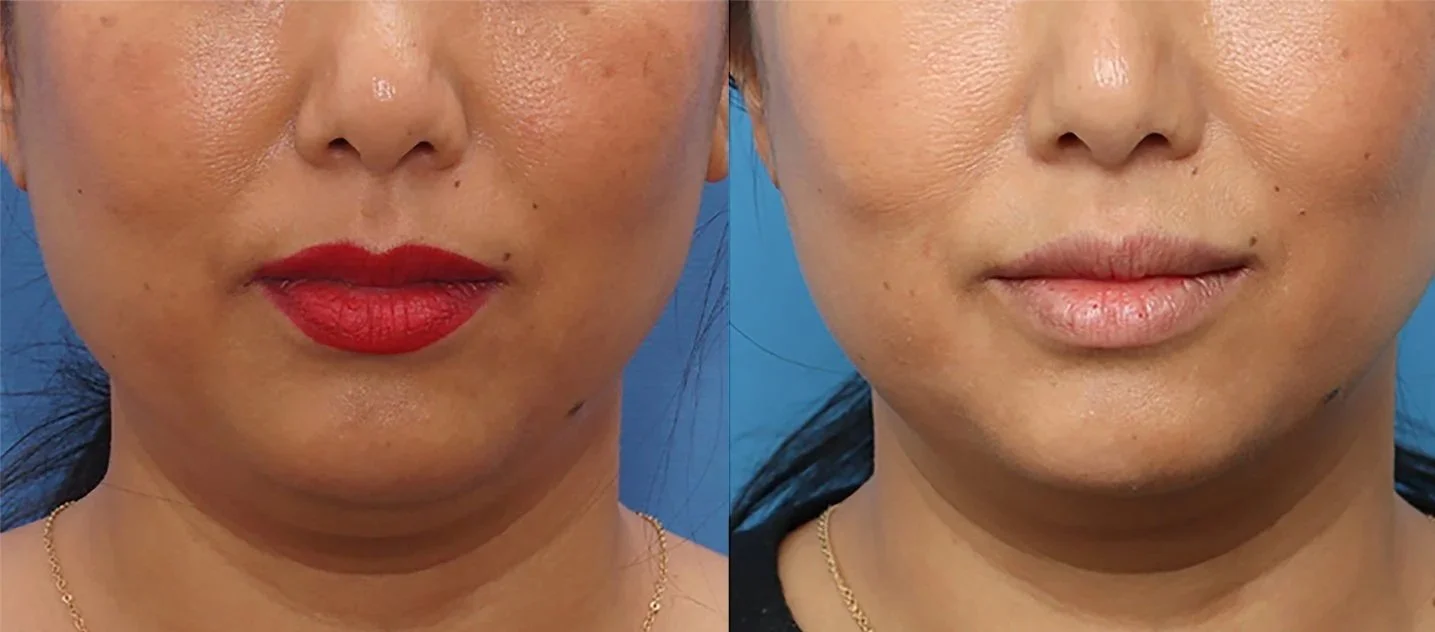Close-up of a woman's face showing before and after cosmetic treatment, with the left side featuring red lipstick and the right side with natural lips.