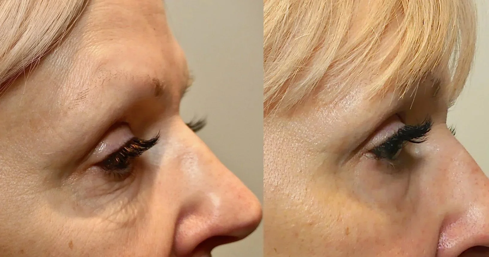 Close-up side view of a woman's face showing before-and-after comparison of facial skin with subtle improvements in skin texture and wrinkle reduction, with the text 'Morpheus8: Dr. B. Forley' in the bottom right corner.