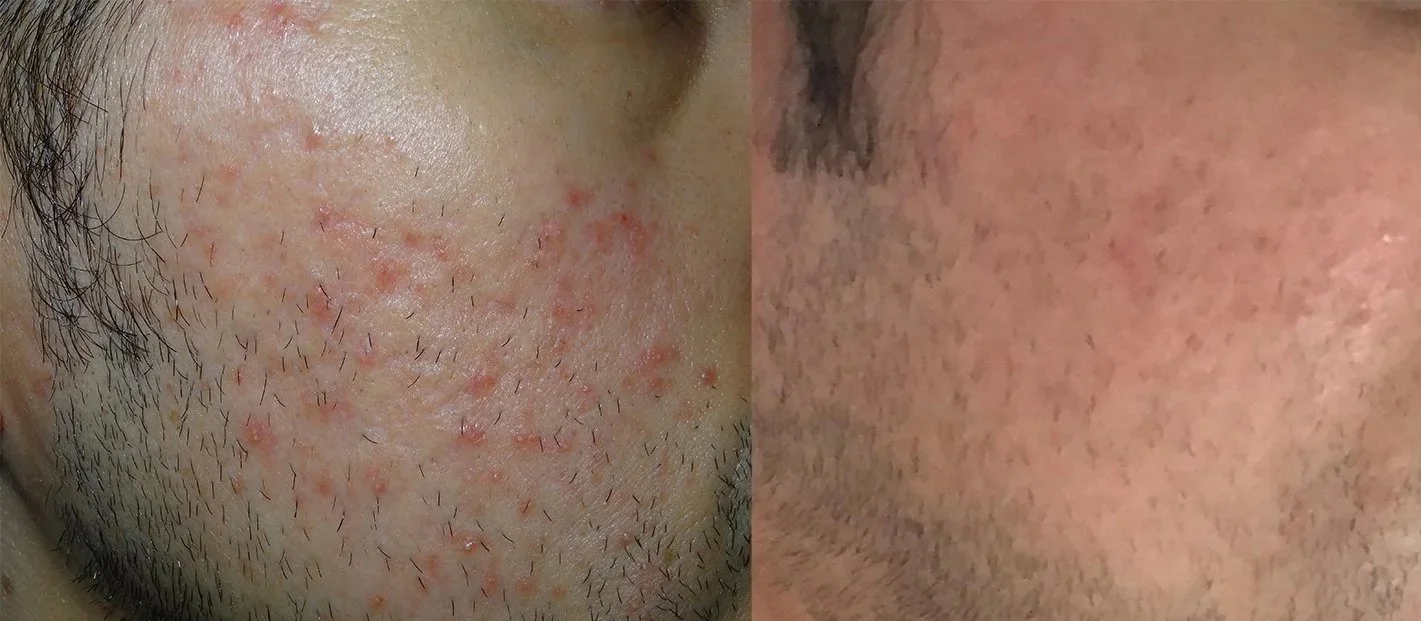 Close-up of a man's face showing significant skin irritation and redness on the left side, with smoother, less irritated skin on the right side.