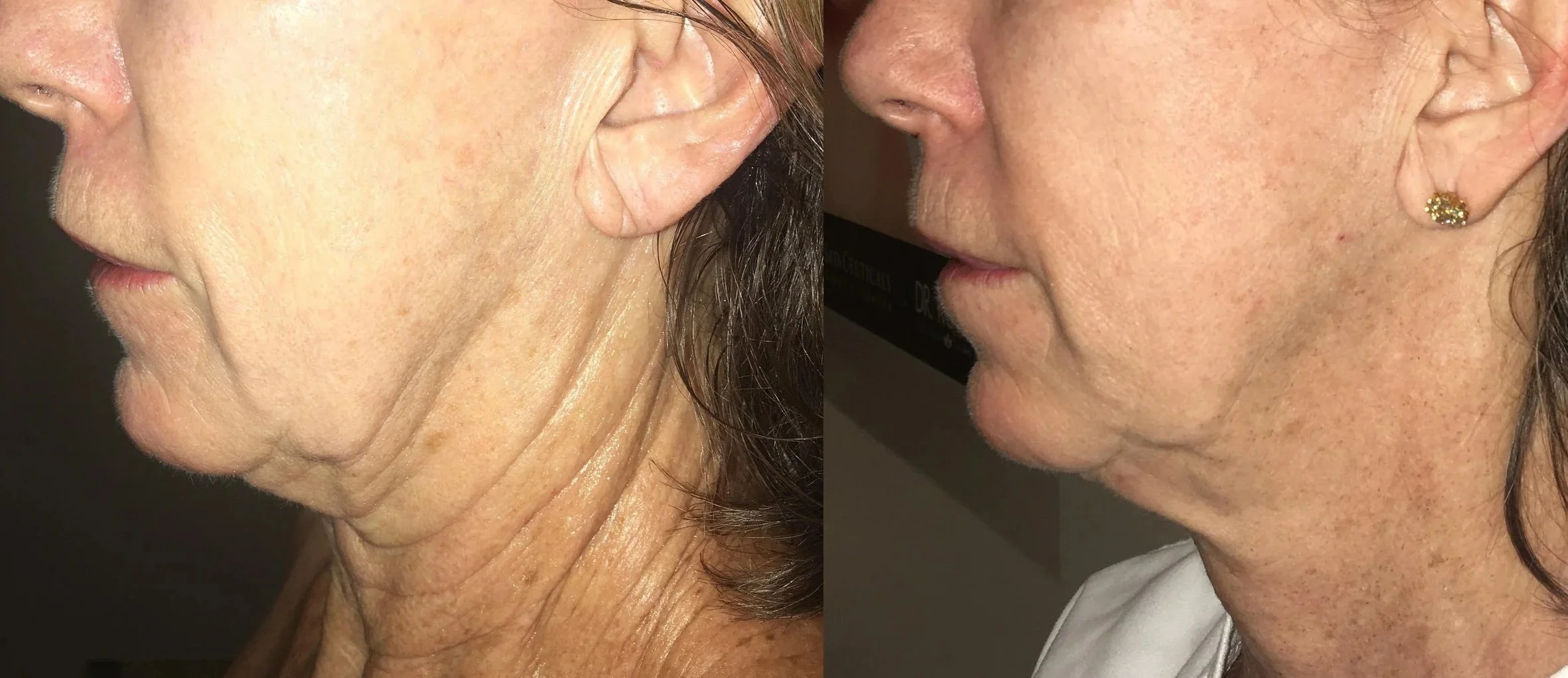 Side-by-side comparison of a woman's neck and lower face; left image shows more wrinkles and sagging, while right image shows improved skin with fewer wrinkles and tighter neck.