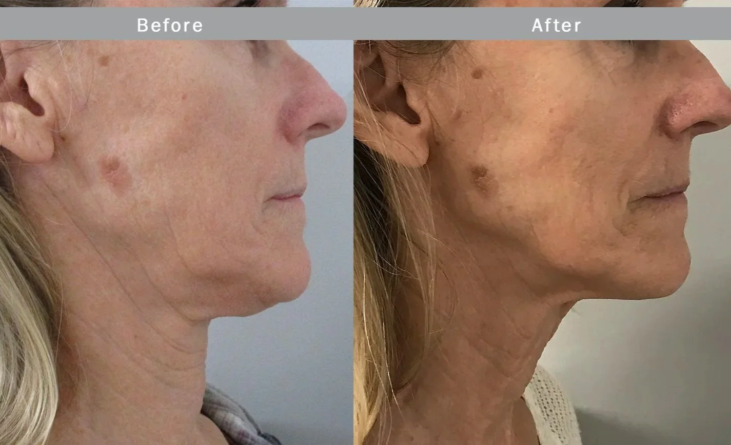 Side-by-side comparison of a woman's face and neck showing before and after skin treatment; before image shows sagging skin under chin, after image shows tighter skin and reduced sagging.