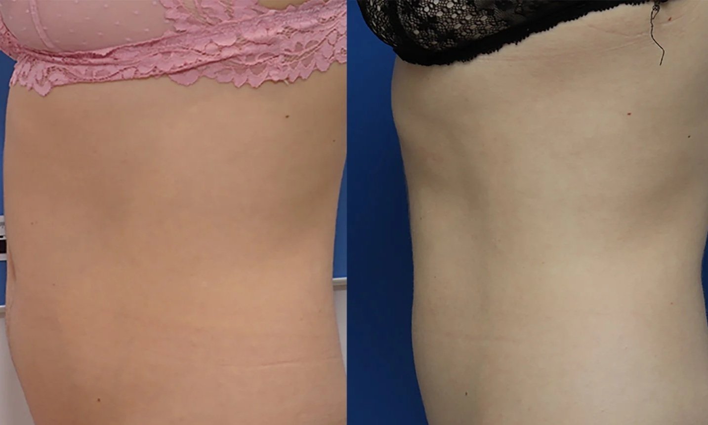 Side-by-side comparison of a person's back before and after cosmetic treatment, showing skin tightening or body contouring results.