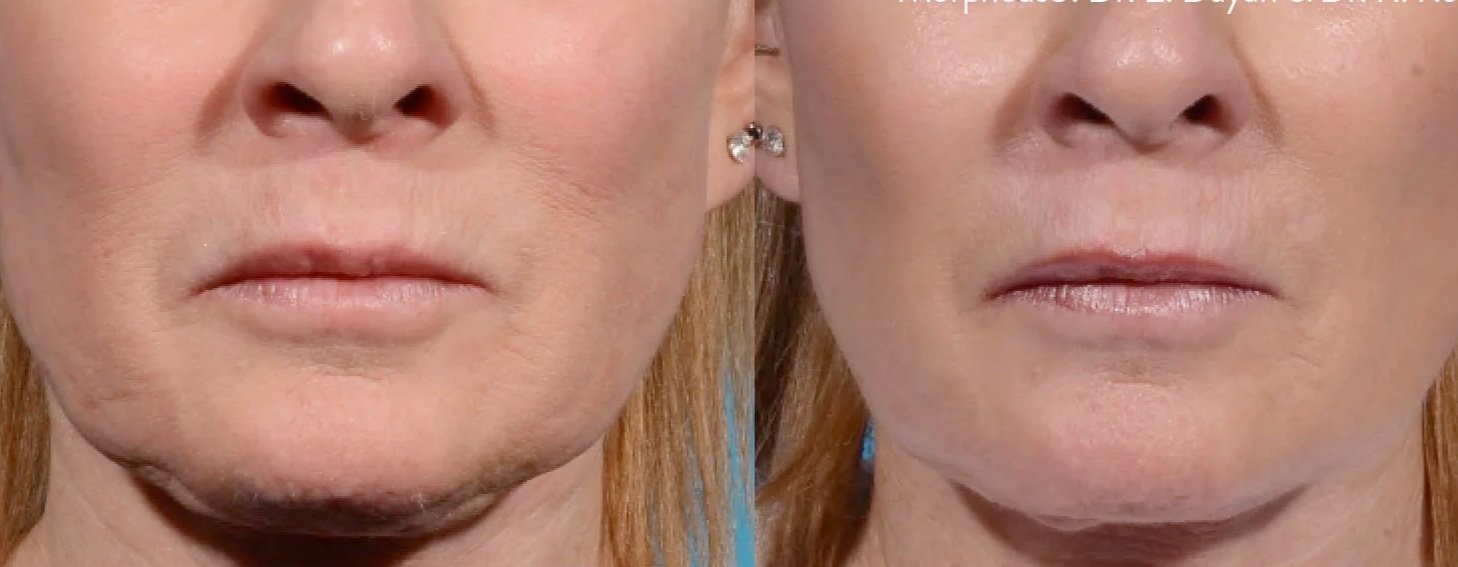 Close-up of a woman's face showing before and after cosmetic treatment results, focusing on the lower face and chin area.
