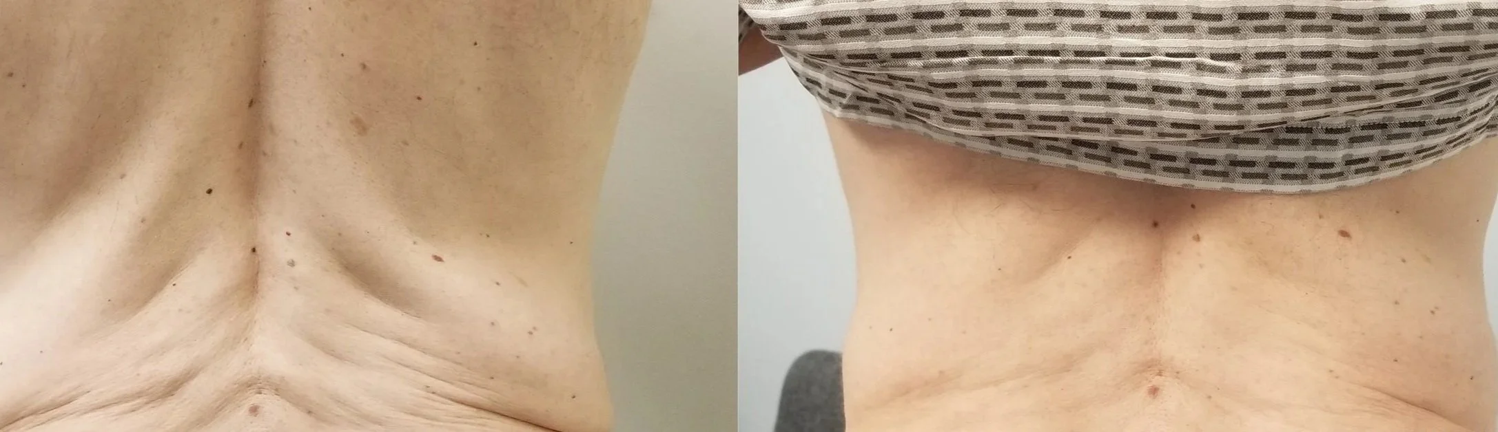 Comparison of a person's back before and after skin tightening treatment, showing improved skin firmness.