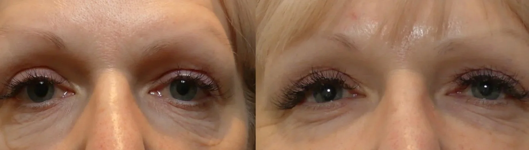 Close-up of a woman's face showing before and after images highlighting facial changes, with eye makeup and visible skin texture.