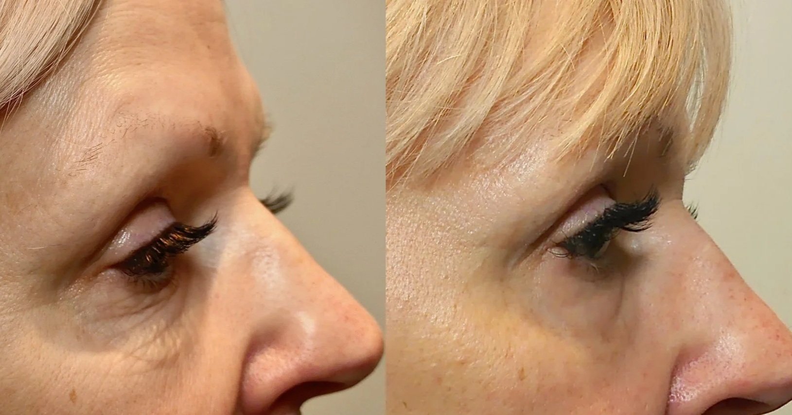 Close-up side view of a woman's face before and after cosmetic or skincare treatment showing reduction in wrinkles and improved skin texture.