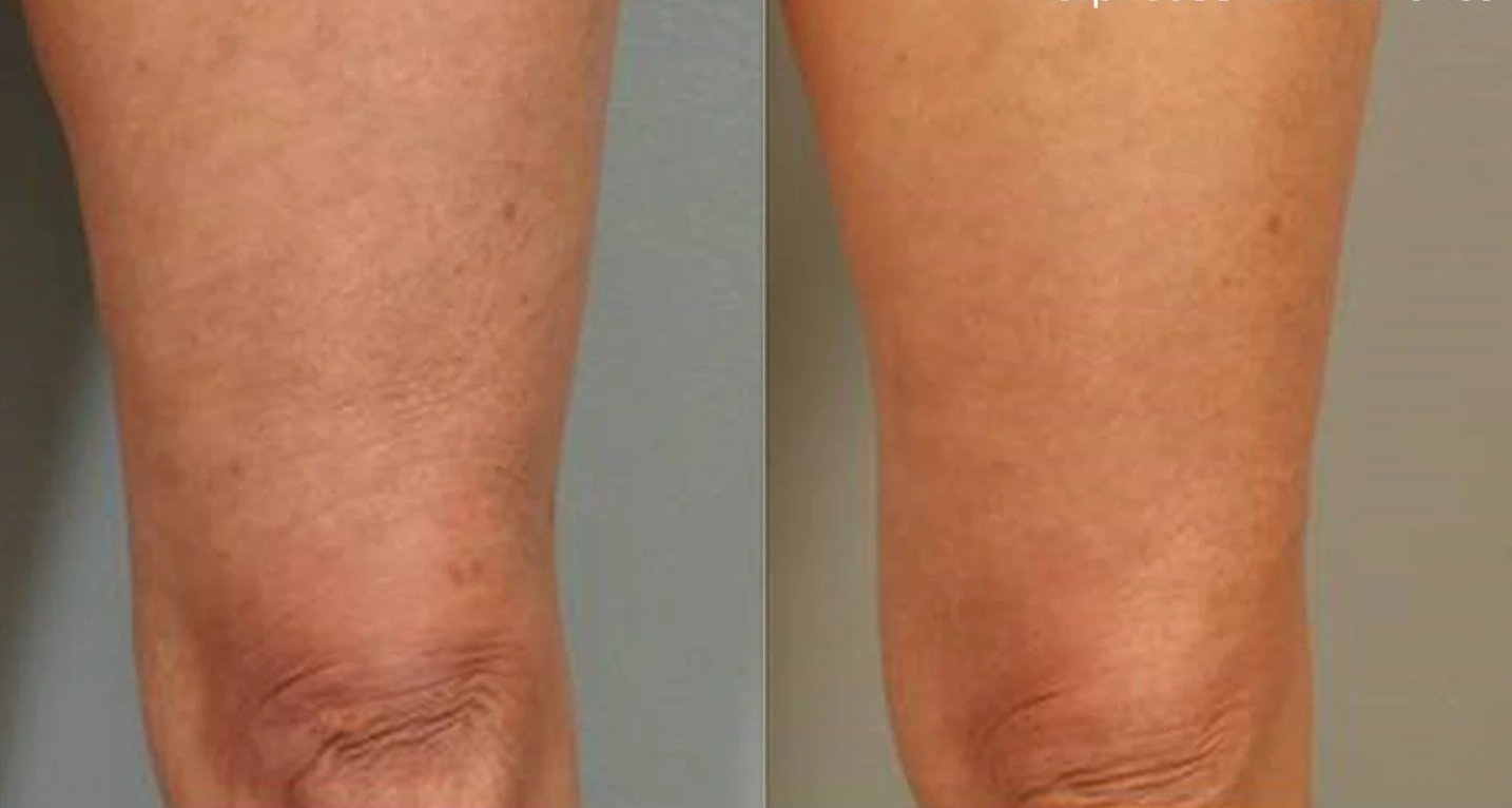 Comparison of a person's leg before and after skin treatment, showing reduced skin pigmentation and improved skin texture.
