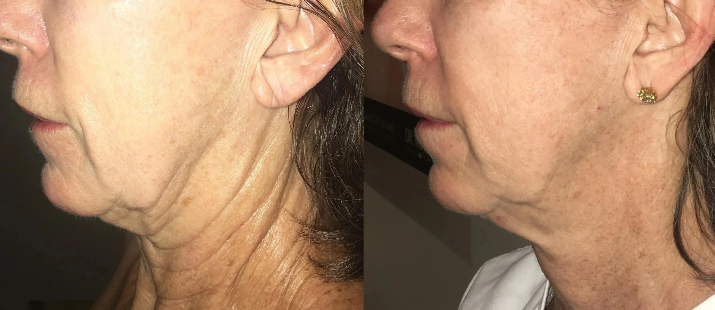 Comparison of a woman's face and neck before and after skin treatment, showing reduced wrinkles and improved skin texture.