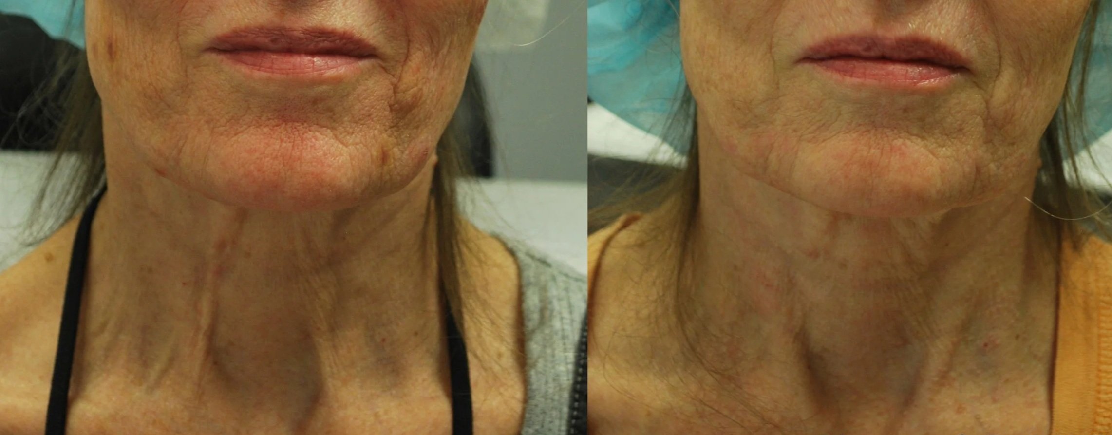 Side-by-side comparison of a woman's neck and lower face before and after a cosmetic procedure, with visible improvements in skin texture and reduction of wrinkles.
