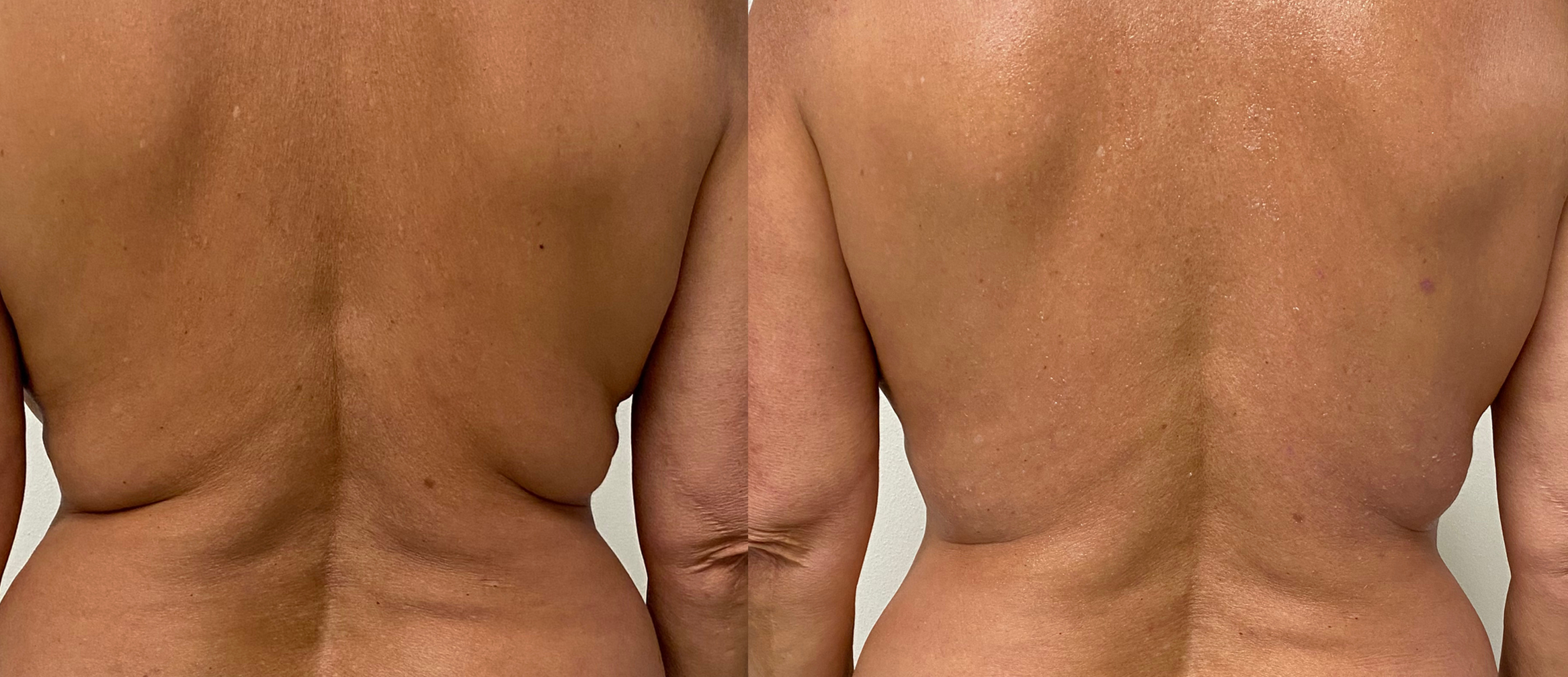 Comparison of a person's back before and after skin treatment showing improved skin texture and tone at Novo Med Spa.