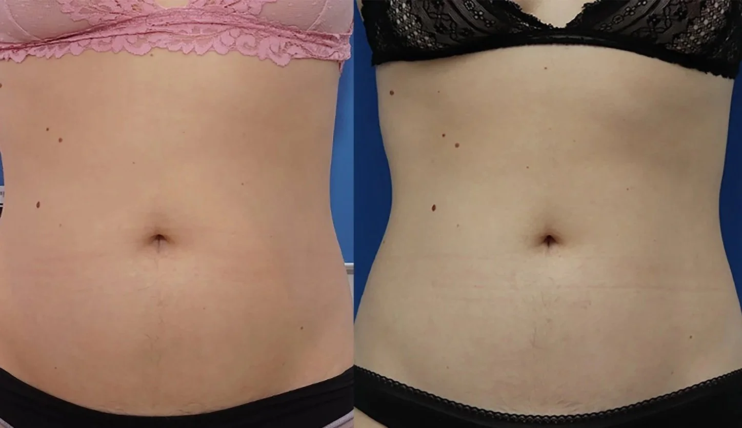 Side-by-side comparison of a person's abdominal area before and after a cosmetic procedure, with the left side showing a slightly fuller abdomen and the right side showing a visibly slimmer waistline.