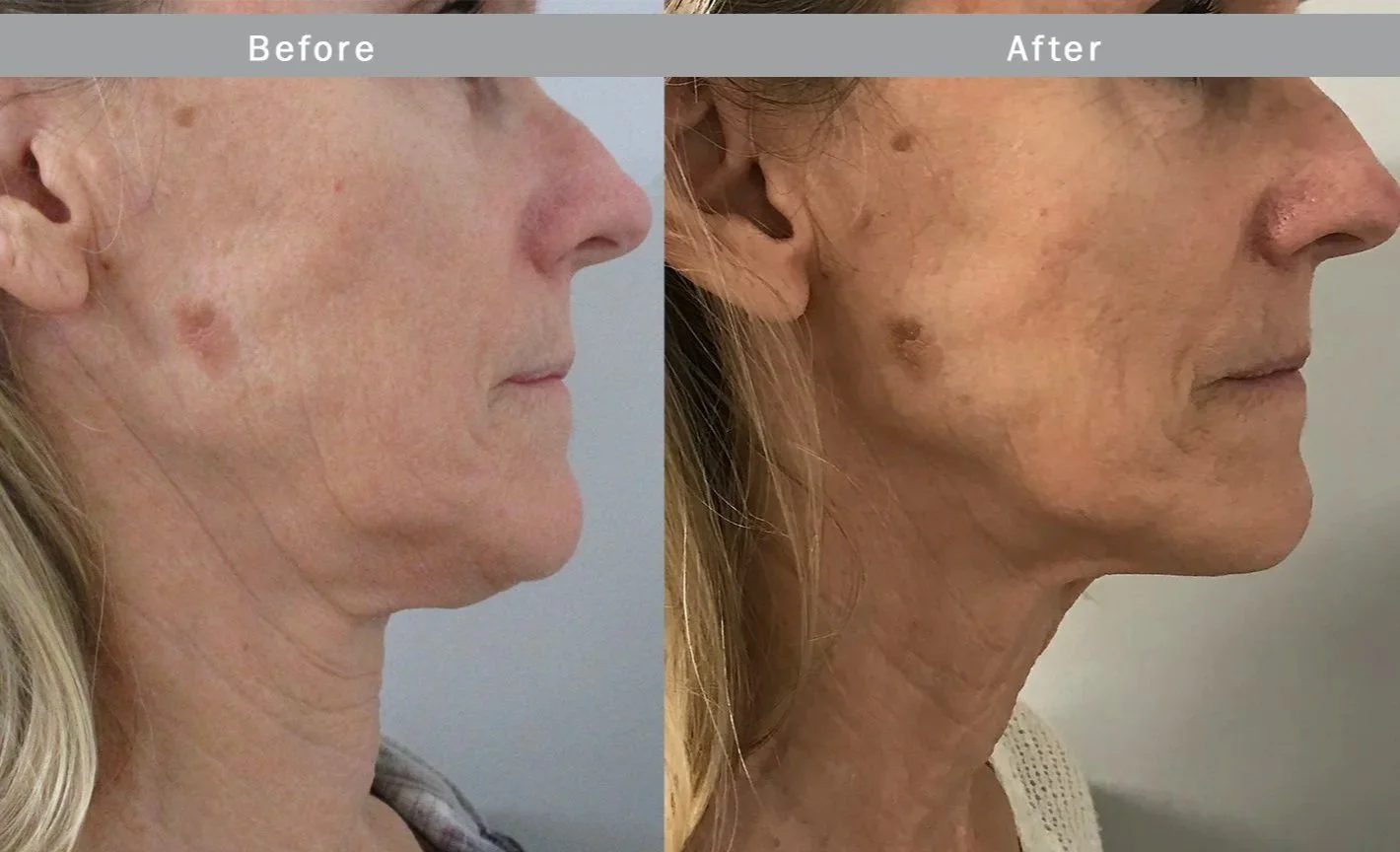 Side-by-side comparison of a woman's face before and after skin treatment, showing improved skin texture and reduced age spots.
