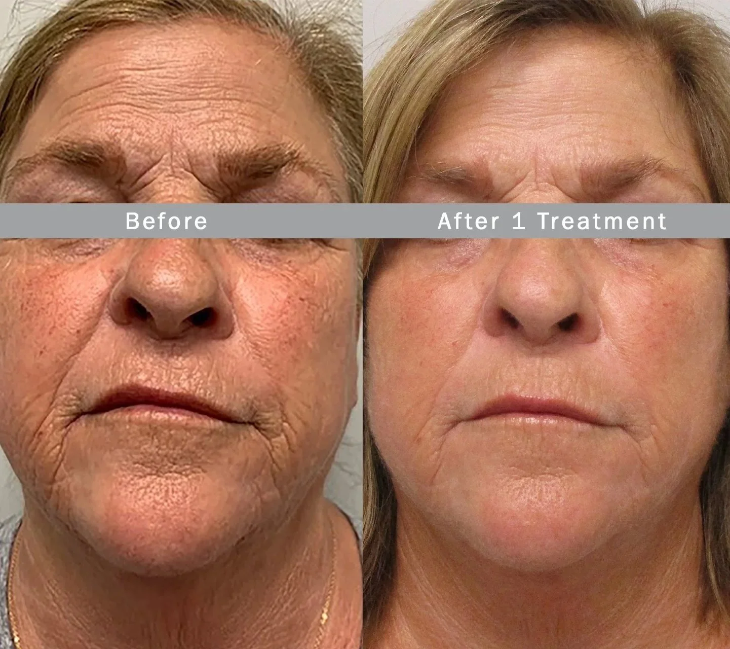 Before and after images of a woman's face showing skin improvement after one treatment, with visible reduction in wrinkles and skin texture.