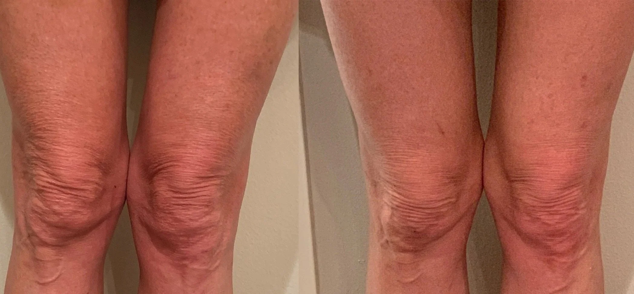 Side-by-side comparison of the back of two knees with visible skin aging, wrinkles, and texture differences.