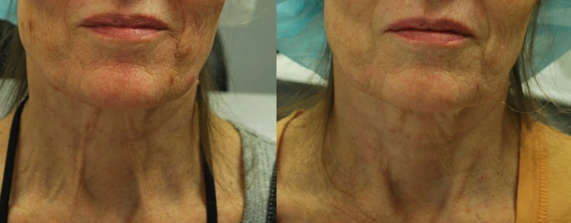 Close-up of a woman's lower face and neck showing before and after skin treatment, with visible improvements in skin texture and elasticity.