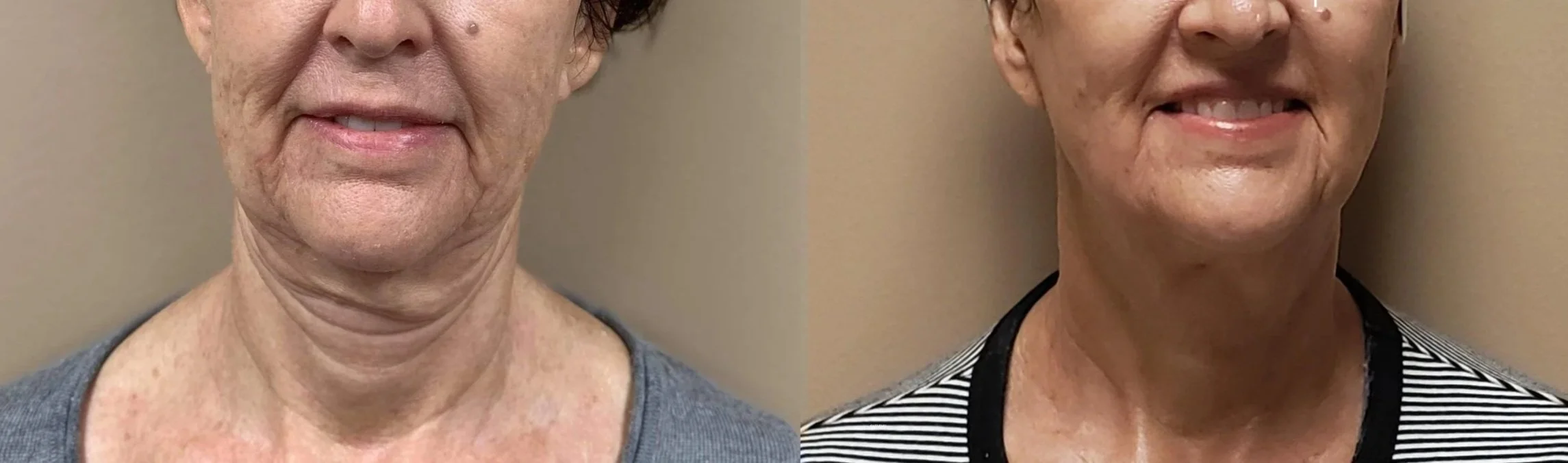 Comparison of an older woman before and after a cosmetic treatment, showing improved skin appearance and a more youthful look in the after photo.