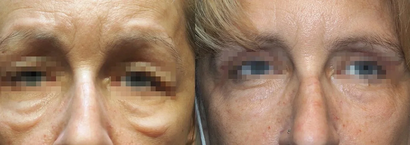 Side-by-side comparison of a woman's face showing before and after a cosmetic treatment, focusing on reduction of under-eye puffiness and wrinkles.