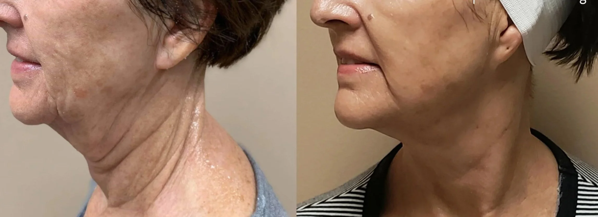 Side-by-side comparison of a woman's face showing before and after cosmetic treatment results, focusing on jawline and neck improvement.
