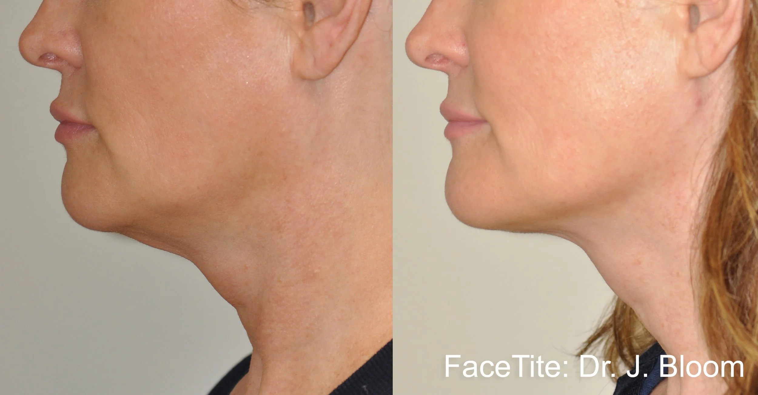 JB_2a_FaceTite_1month_49yr.jpg