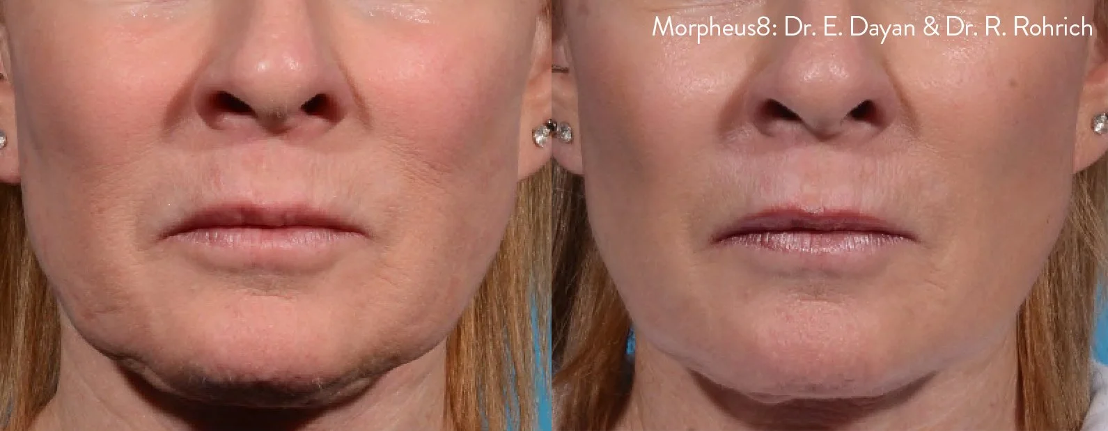 Morpheus8_Before&After (17).jpg