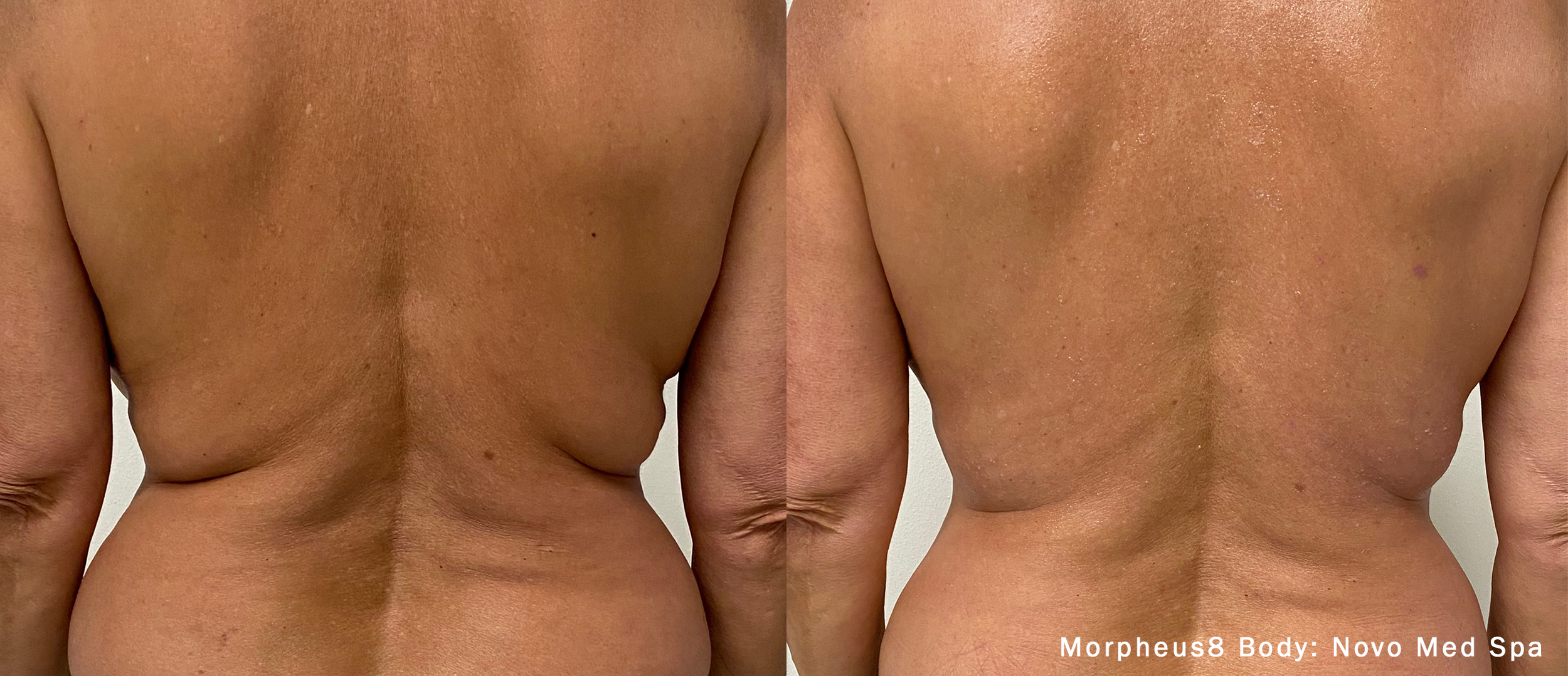 Morpheus8 Body Before & After.png