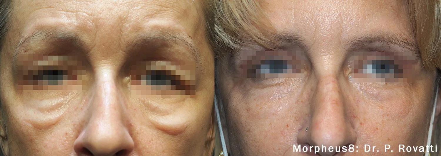 Morpheus8_Before&After (10).jpg