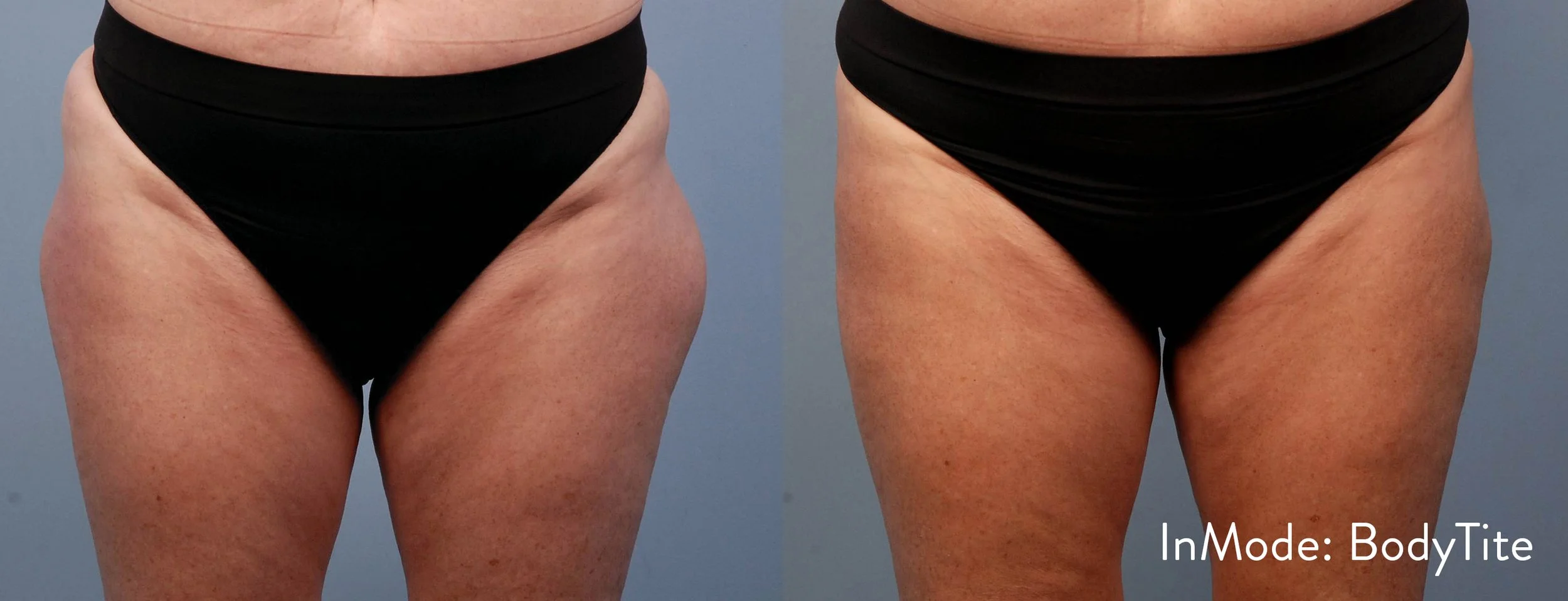 IM_Stephen-Mulholland-Thigh-6Wk.jpg