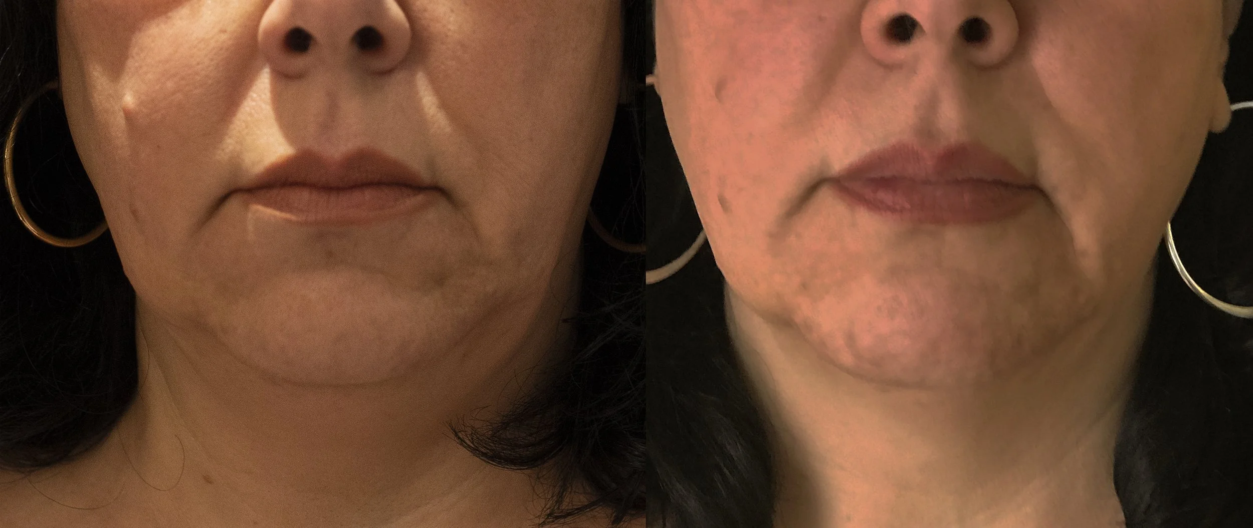 IM_Morpheus8_1a_Before_3MonthsAfter.jpg