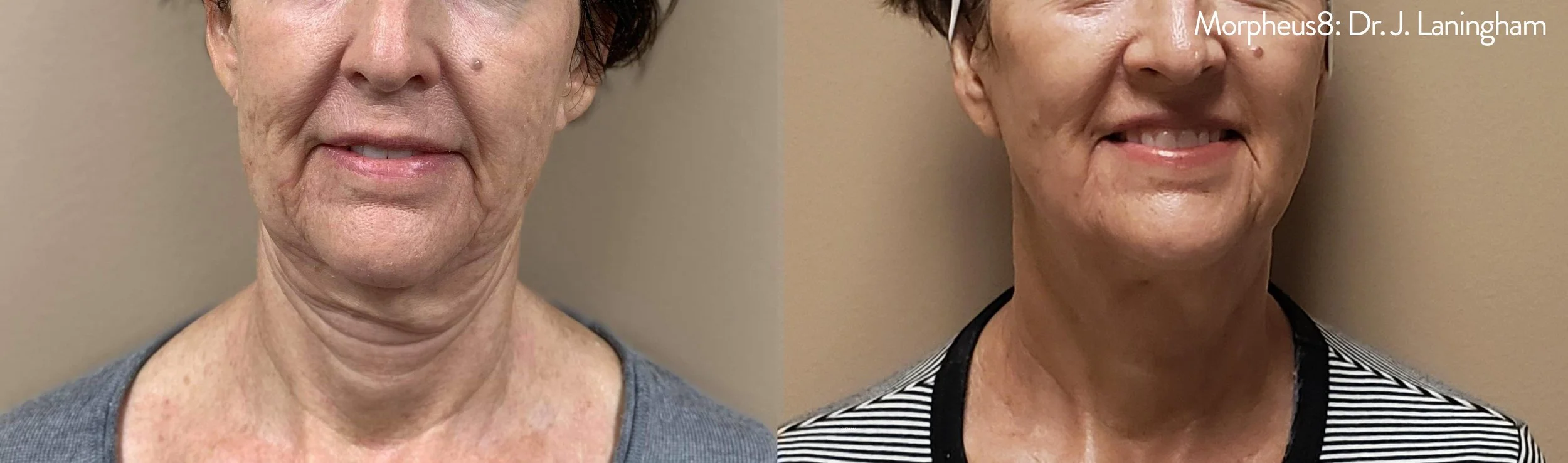Morpheus8_Before&After (9).jpg