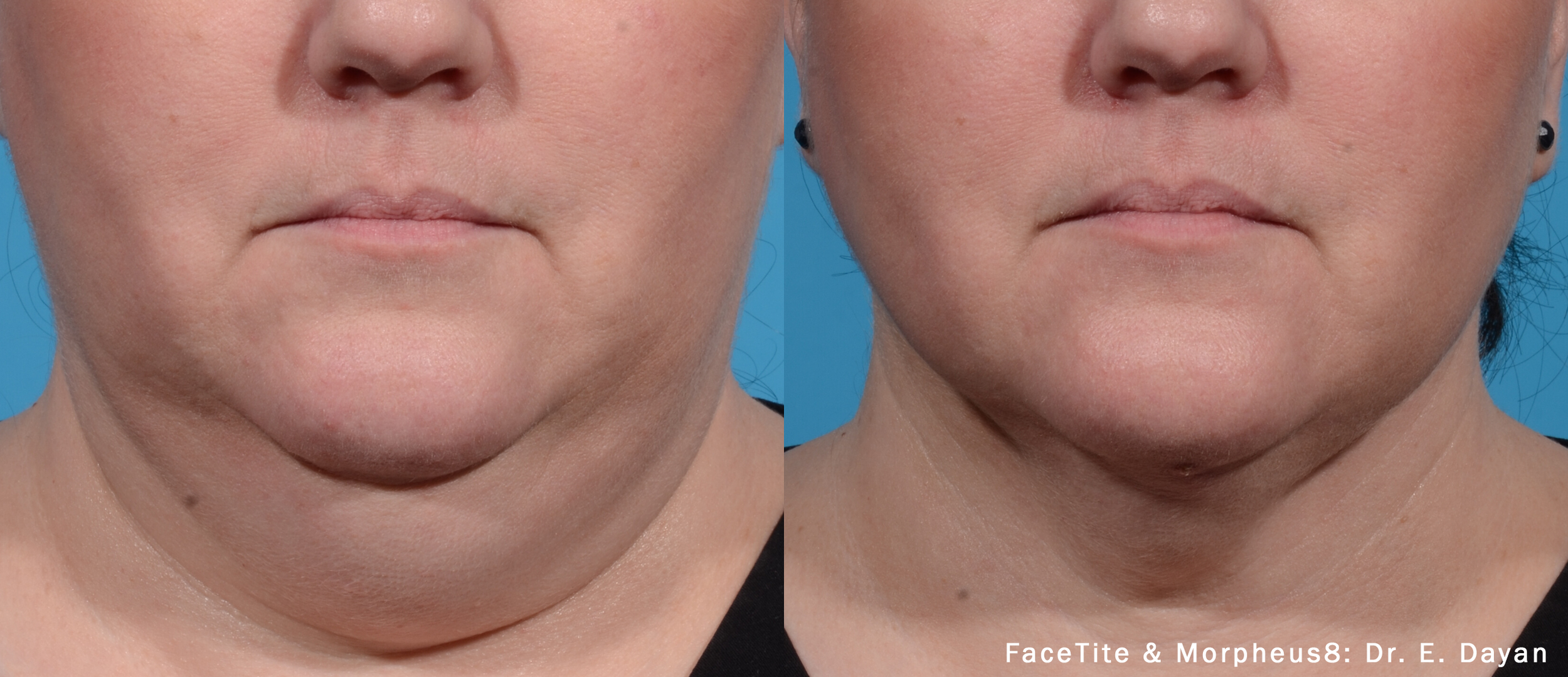 facetite-morpheus8-before-after-dr-e-dayan-preview-1.png