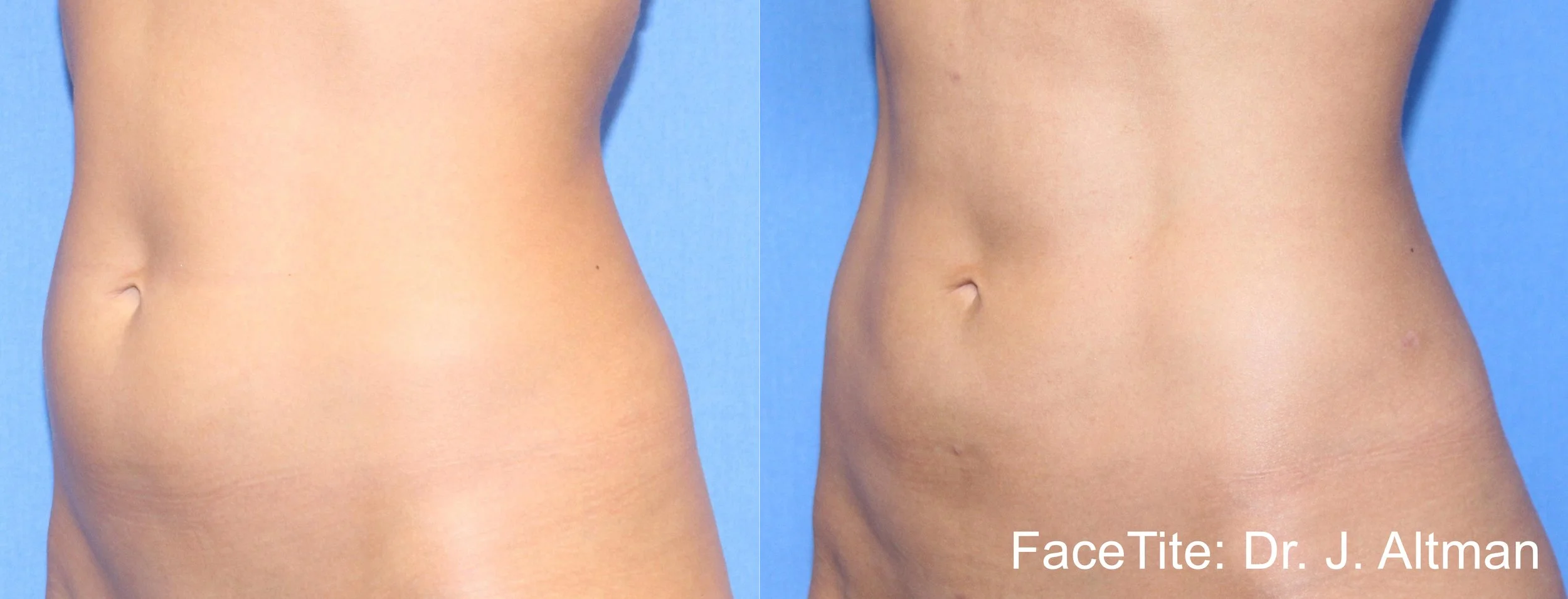 JA_FaceTite_Abdominal.jpg