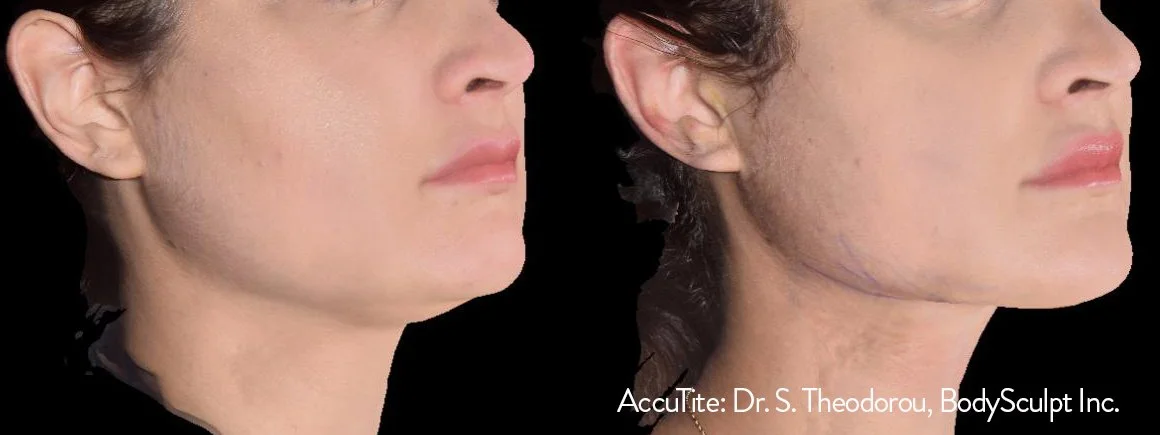 ST_1e_AccuTite_3D_RightCropped_25_EK_48Hrs.jpg