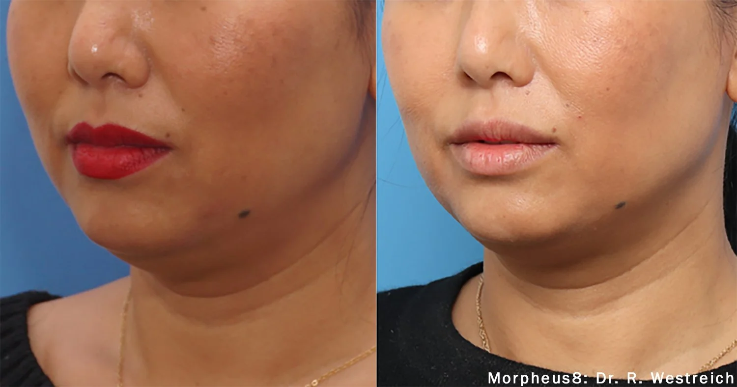 Morpheus8_Before&After (16).jpg